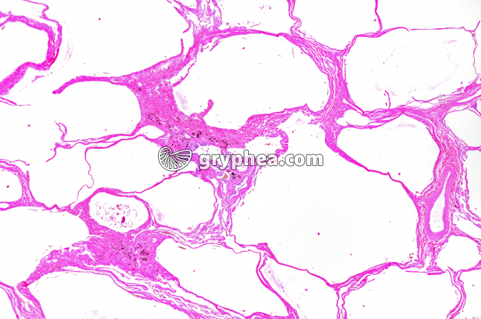 Emphysème pulmonaire x6 - gryphea.org